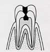 LEVEL2　歯髄まで達するもの [C3]